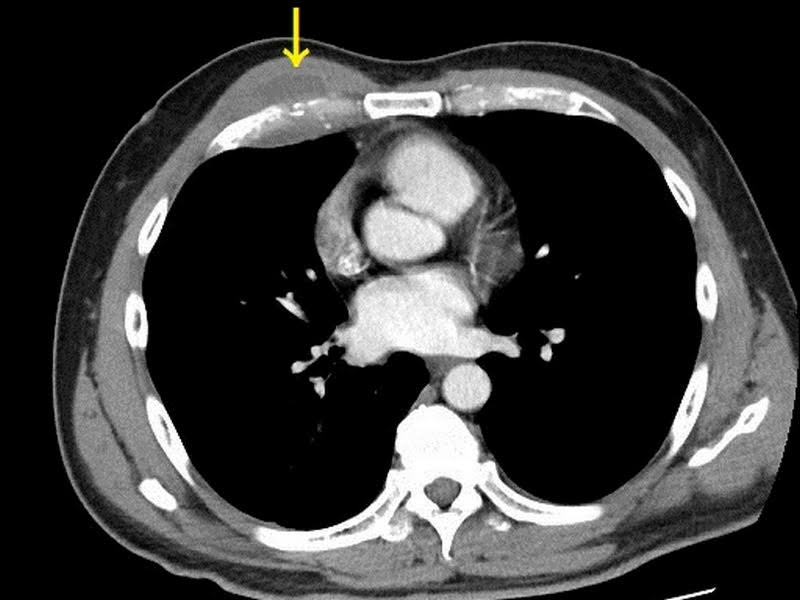 電腦斷層發現胸腔膿瘍，所幸膿瘍範圍雖大，但尚未侵蝕肋膜。   圖：台北慈濟醫院提供