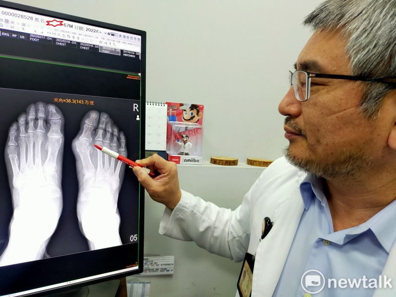 楊志鴻主任說，第一、二蹠骨間的夾角大於25度，應該考慮動手術。   唐復年/攝