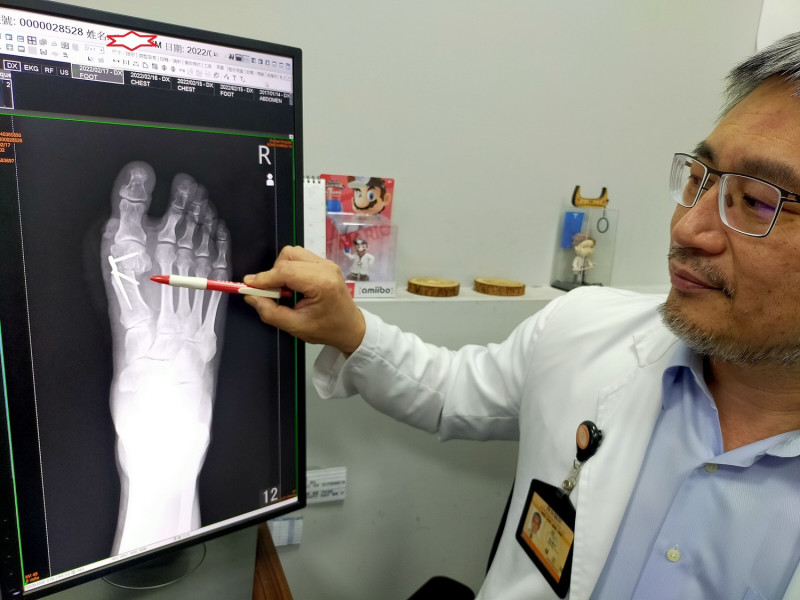 楊志鴻主任說，近年有新式的微創矯正手術，搭配鈦合金材質的矛型骨板、骨釘，術後不用打石膏，兩周後可以正常行走，讓病人快速回到正常生活形態。   唐復年/攝