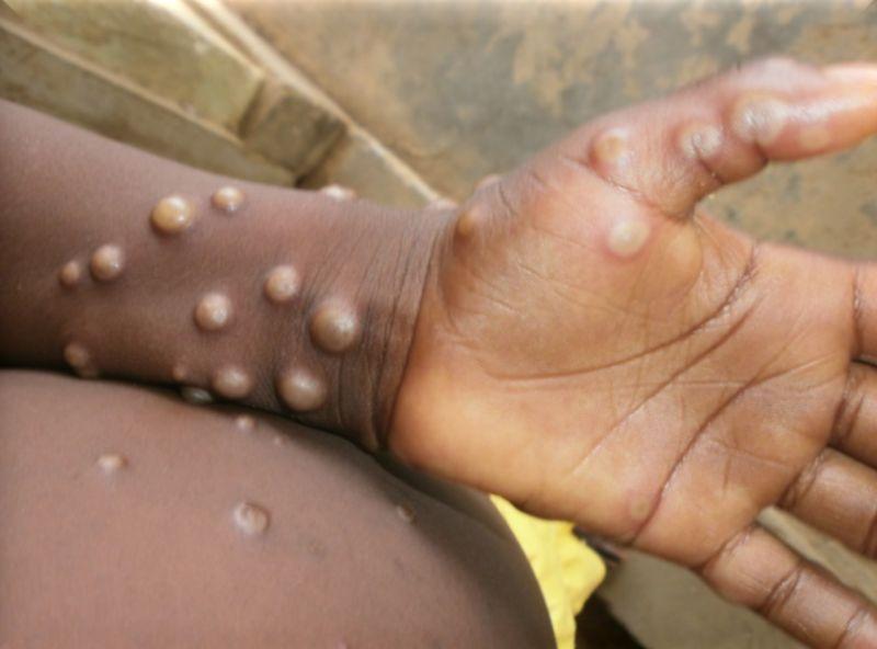 人感染猴痘的初期症狀包括發燒、頭痛、肌肉酸痛、背痛、淋巴結腫大等，之後可發展為面部和身體大範圍皮疹。   圖：翻攝自世衛官網（資料照）