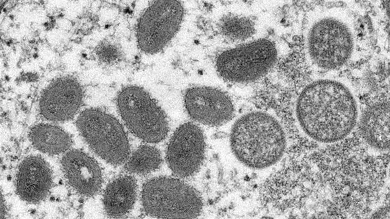 美國出現首例猴痘與新冠肺炎同時感染的個案。   圖:翻攝自美國疾管署網頁cdc.gov