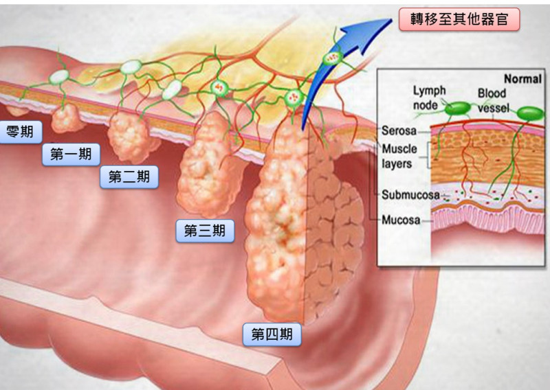 醫師許秉毅表示，大腸癌多發生在50歲已上的成人，但目前大腸癌症逐漸「年輕化」，就算年輕、不菸、不酒也可能得大腸癌。   圖：翻攝自許秉毅臉書