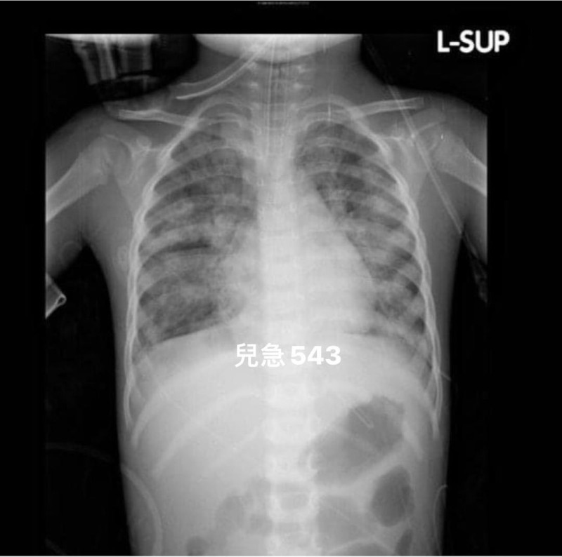 近年嚴重RSV感染的胸部X光片。   圖：翻攝自吳昌騰醫師臉書