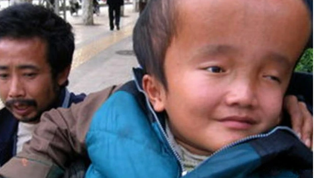 2008年時中國嬰幼兒品牌三鹿，在奶粉裡摻入三聚氰胺，讓嬰幼兒喝了以後成為「大頭寶寶」模樣驚人！也造成日後中國人至香港與他國搶購奶粉，曾一度讓香港人無法買到奶粉。   圖：翻攝自勝訊網-「彤妈说育儿」網頁