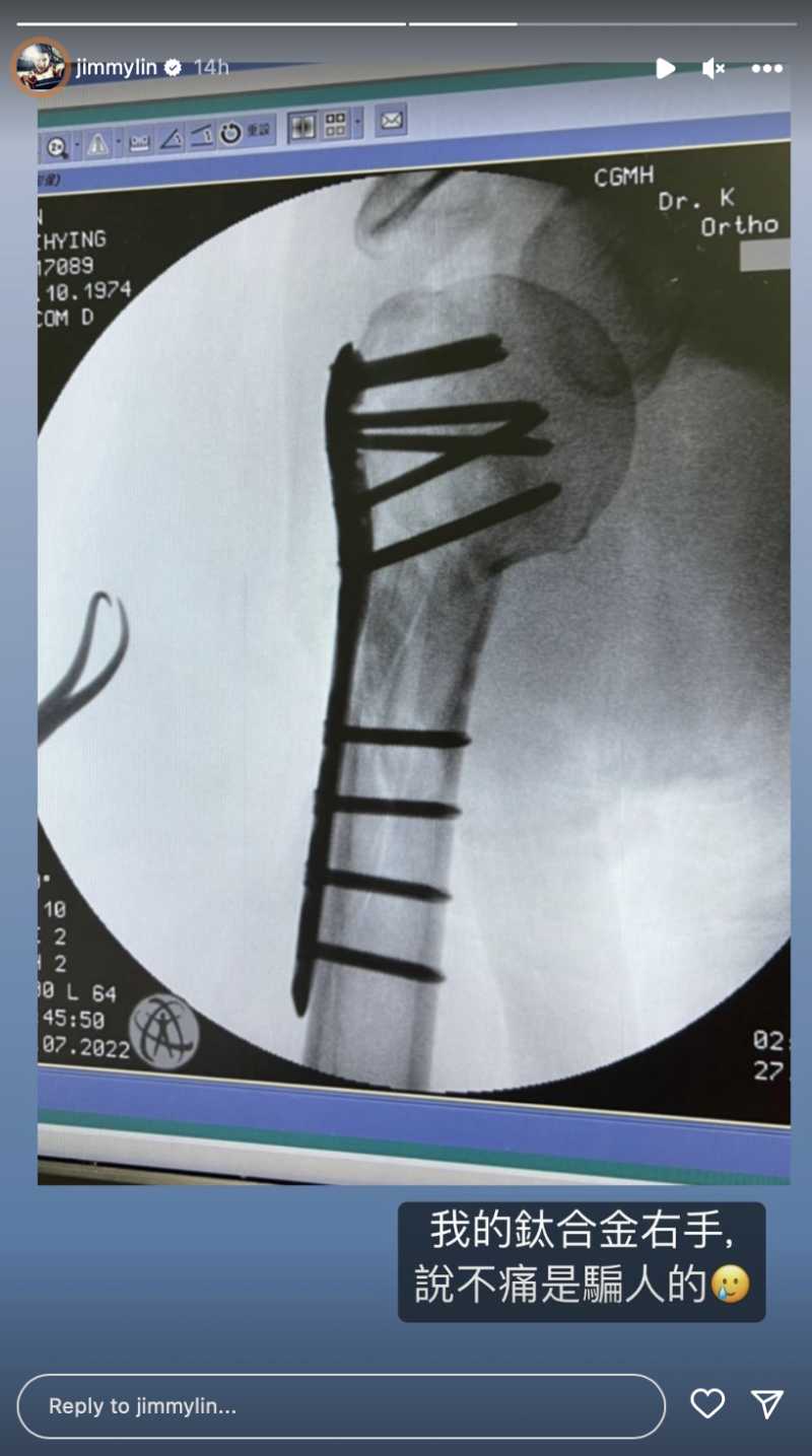 林志穎也首度曬出「鈦合金手臂」，苦笑表示「說不痛是騙人的」。   圖：翻攝自林志穎IG