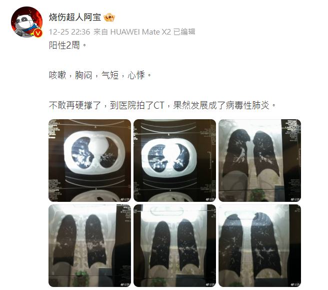 中國網紅燒傷科醫生「燒傷超人阿寶」在微博上發文，稱自己陽性兩周，出現嚴重症狀才就醫。   圖:翻攝自「燒傷超人阿寶」微博