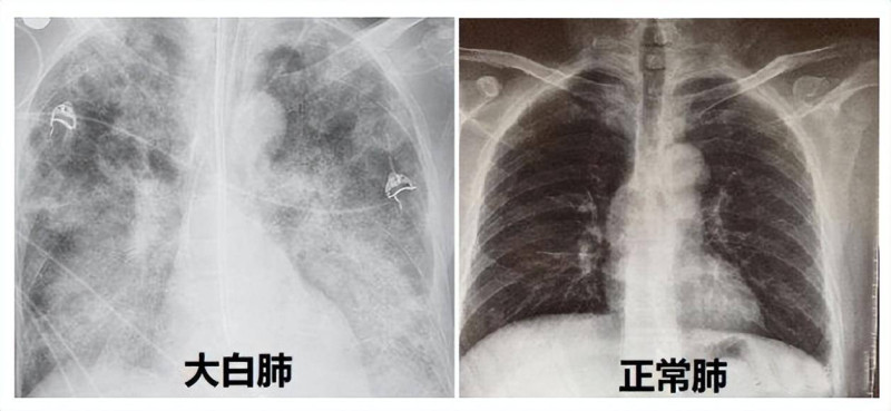 中國網傳許多「大白肺」圖片。 圖：翻攝自搜狐（資料照）