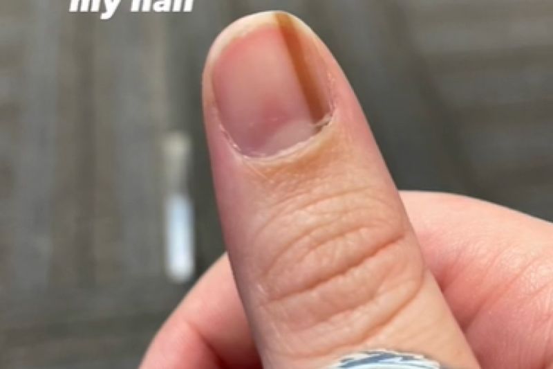 美國一名女子指甲上長出淺棕色直線，一查竟是罕見癌症，差點被截肢。   圖／TiKTok：frankenthumbttv