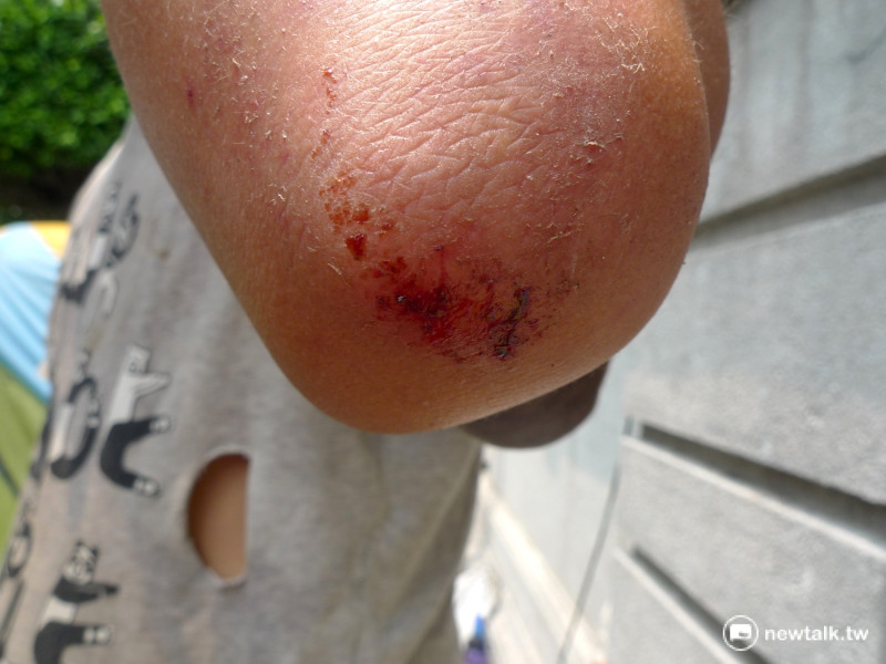 聲援者許光甫控訴被警方推倒在地，造成手肘擦撞受傷。   圖：汪少凡／攝