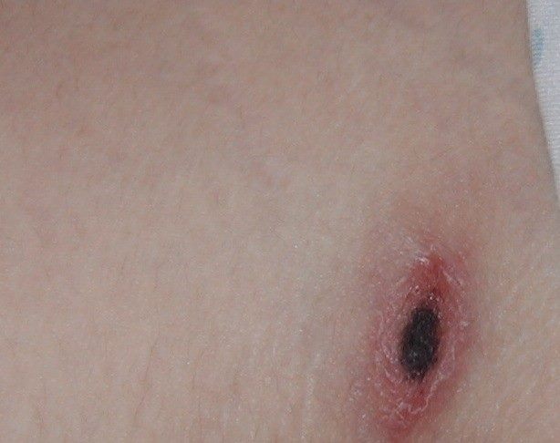 恙蟲叮咬處通常會出現「焦痂」，是此疾病的重要特徵。   圖：取自台北市政府衛生局