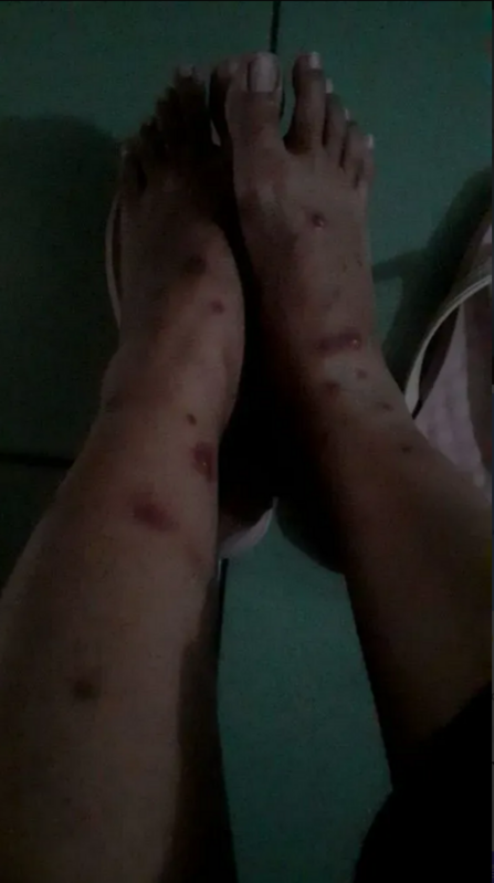 「爆料公社」一文指一名外籍女看護照顧台灣阿嬤時卻被傳染猴痘，已收治隔離並確診。   圖：翻攝自爆料公社