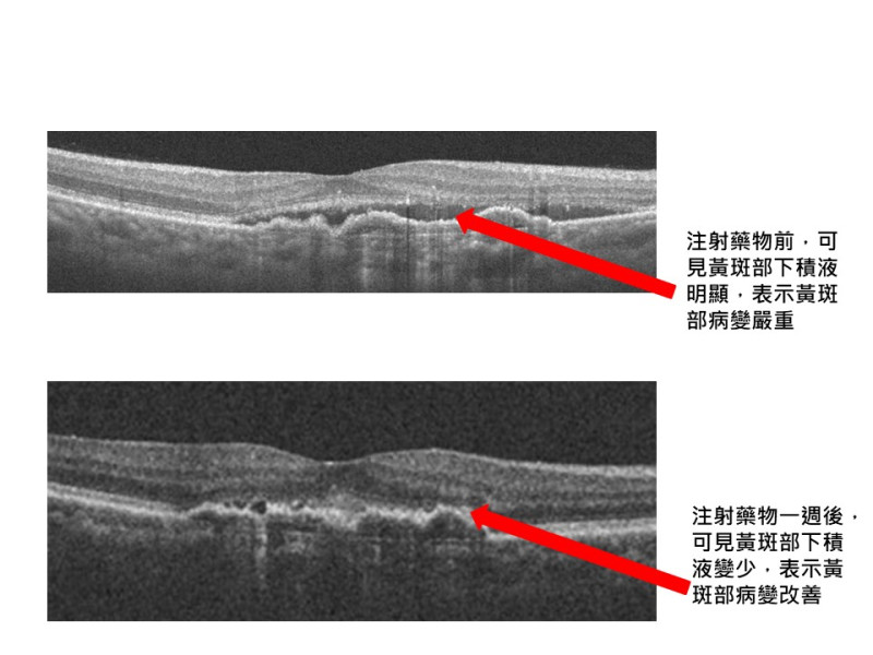 一位59歲黃斑部病變患者使用新藥一週，即發現他的黃斑部積水減少，新生血管也變小，視力也有所提升。   圖：亞東醫院/提供