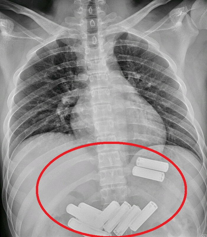 一名男子竟吞了11顆3號電池，於深夜送至苗栗市大千綜合醫院急診。經過腹部X光檢查，發現所有的電池都在胃腔裡，且與大量食物混合。   圖：大千醫院／提供