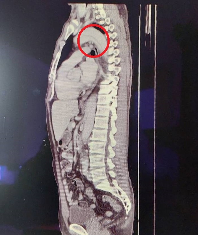 劉先生經電腦斷層檢查，發現為急性主動脈剝離(紅圈處)。   圖：大千醫院／提供
