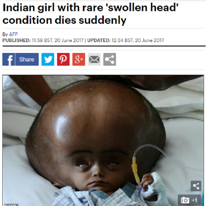 印度大頭女童羅娜貝岡（Roona Begum），原本下個月要接受矯正手術，因出現呼吸困難，她的家人證實18日已在家中病逝。   圖：翻攝Daily Mail網站