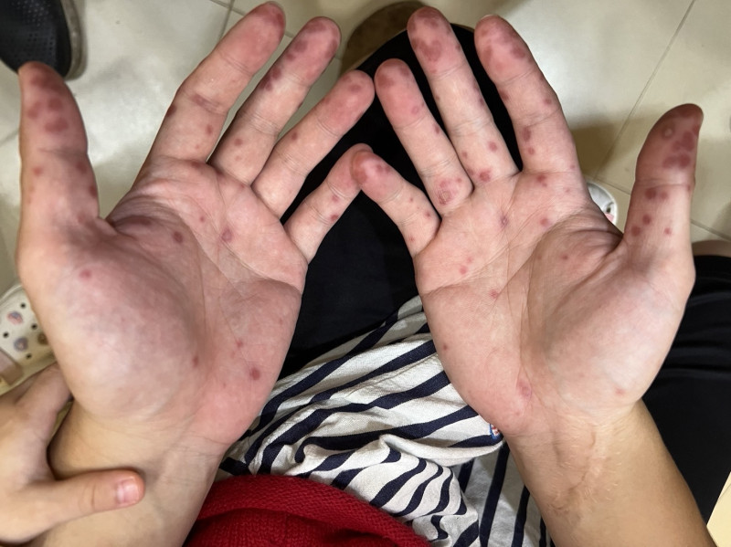 施勝桓醫師表示，腸病毒是一種高傳染性的疾病，不但一年四季都有可能感染，成人、幼兒均有感染風險。   圖：施勝桓醫師／提供