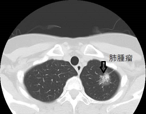 肺腫瘤及肺癌示意圖。   圖：取自衛生福利部桃園醫院