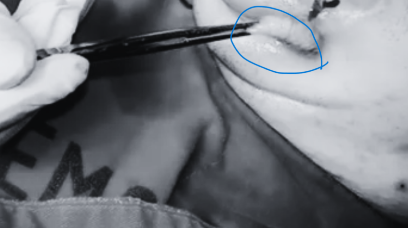 一名一名33歲男子自秘魯返國後因嘴唇局部腫脹、疼痛、化膿，被檢查出為馬蠅蟲卵寄生案例，馬偕醫院今公開其治療與手術過程。   圖：翻攝自馬偕醫院手術影片