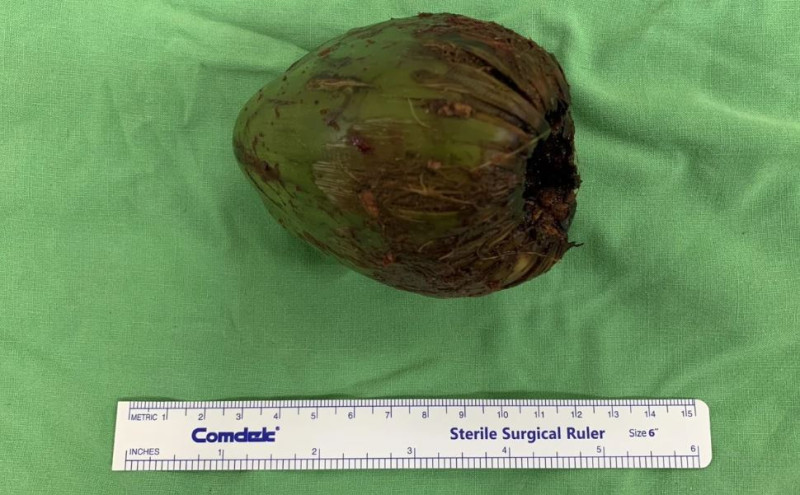 男子直腸塞進一棵小椰子，造成大小便困難，這起案例2023年1月刊登在英國外科雜誌。   圖：義大提供