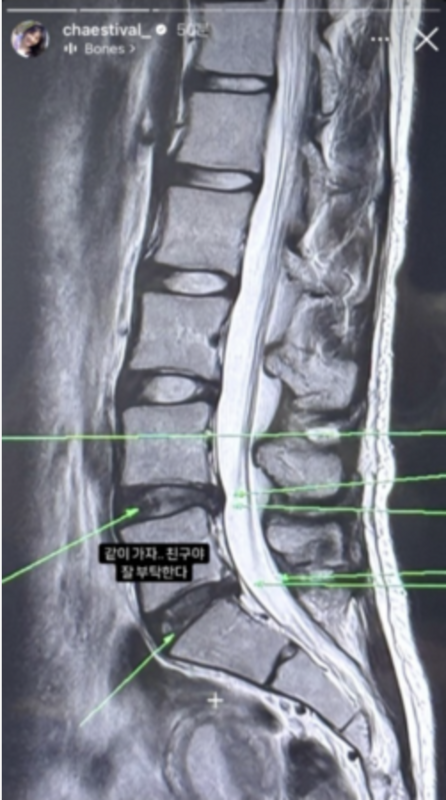 李彩演在IG發出自己腰椎X光照片，透露自己因腰部不適前往醫院檢查。   圖：攝自IG／ chaestival_