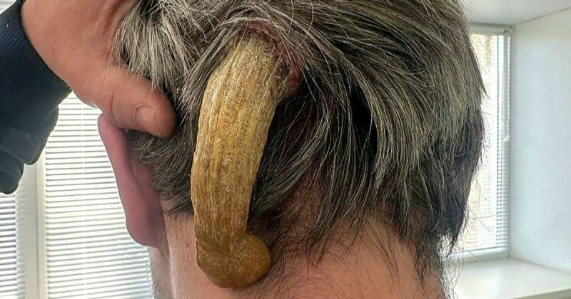 俄國一名男子後腦突然長出巨大的惡魔角，最後就醫透過手術切除。（翻攝X@DailyMirror）   