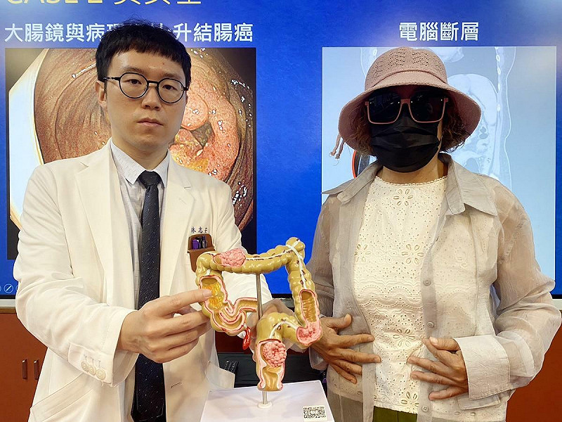 林志安醫師(左)與外科團隊運用複合型達文西手術,助吳小姐(右)同時切除胃腸道基質瘤、大腸癌與肝轉移腫瘤。 圖:台中榮總提供