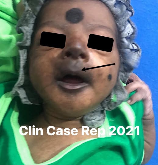 吳昌騰提醒屈公病危害新生兒，曾有12天男嬰出現發燒與臉部發黑，確診為蚊媒感染。   圖：翻攝自來講兒科急診的543-吳昌騰醫師　臉書專頁