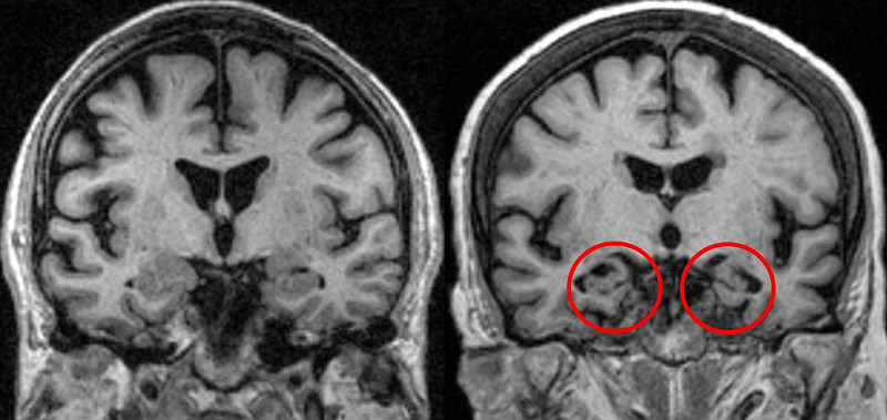正常大腦(左圖)與失智症患者大腦(右圖)對比，海馬迴明顯萎縮。   圖：光田綜合醫院/提供