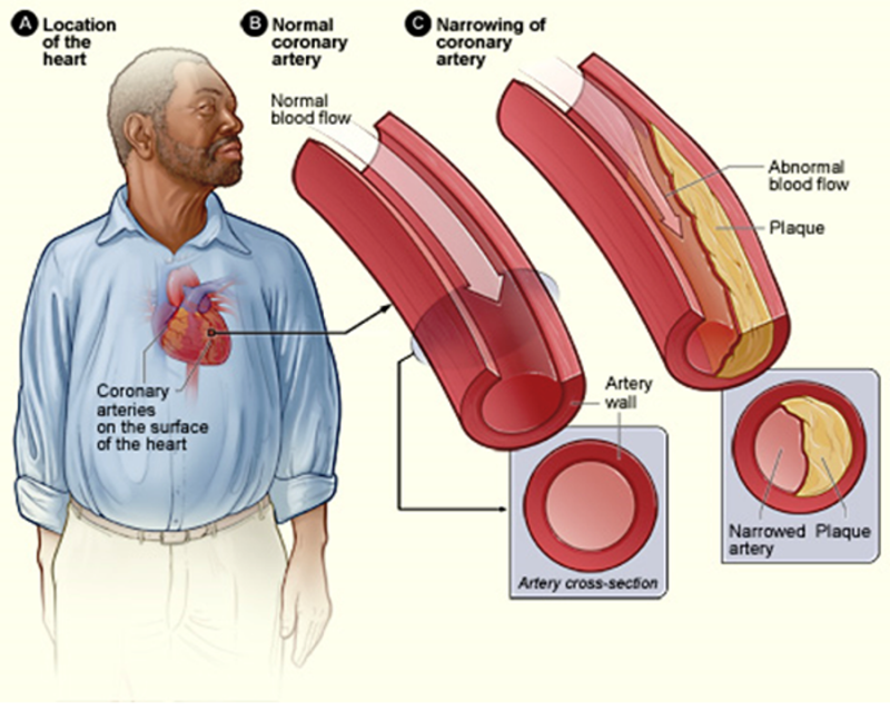 2011年，全球共有700萬人死於缺血性心臟病，居10大死因之首。圖為缺血性心臟病之說明。圖片來源：維基共享資源公共領域(Public Domain)。   
