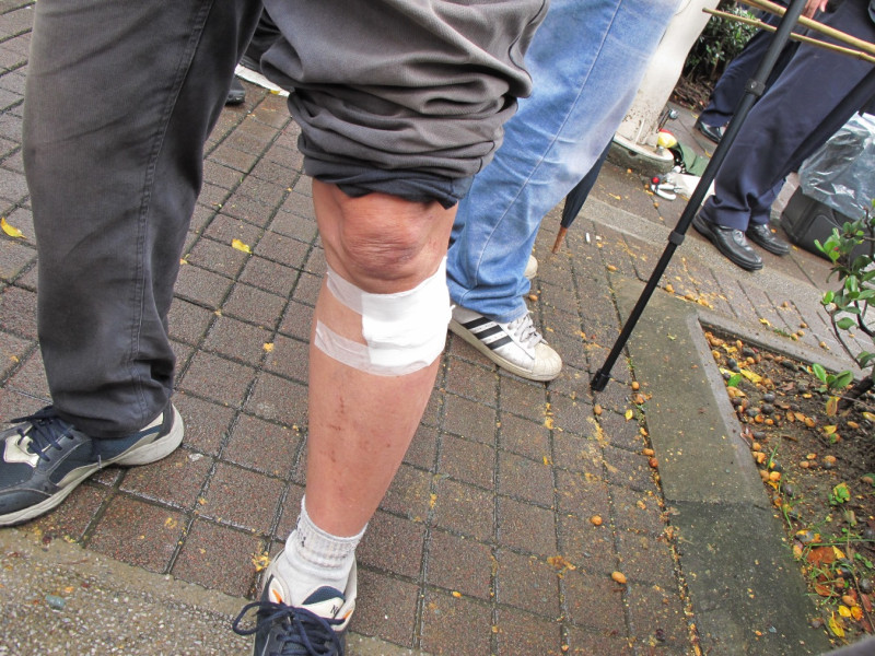 抬離時受傷的民眾出示擦傷左腿，但他不願意坐上警方叫來的救護車。圖：林朝億/攝   