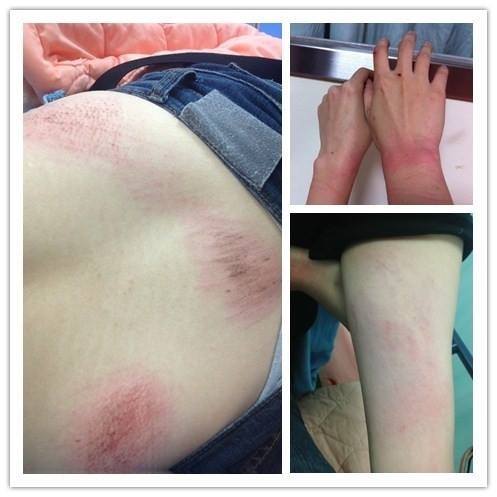 昨晚參與立法院靜坐抗議活動的女學生控訴，她被警方拖拉毆打，造成全身都是傷。圖：翻攝自戴立忍臉書。   