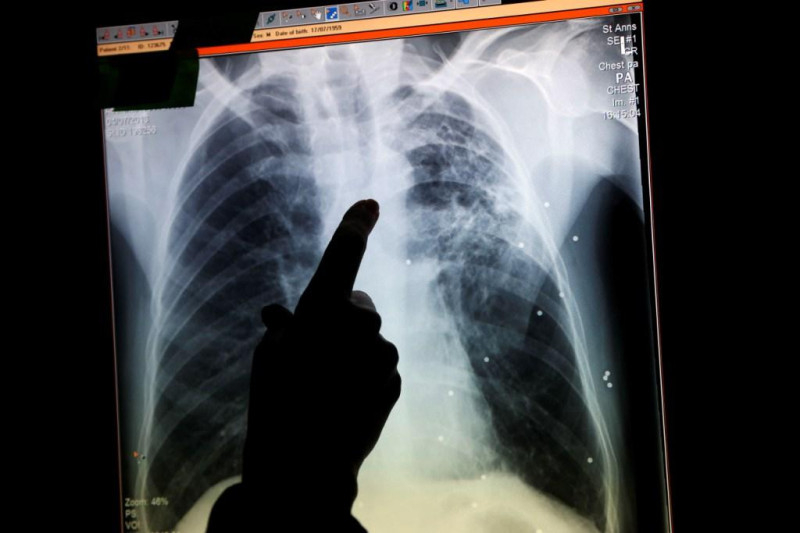 世界衛生組織(WHO)根據2013年肺結核年度報告指出，2012年肺結核一共在全世界奪走了130萬條的生命，是全世界致死人數排名第2的傳染病。圖片來源：達志影像/美聯社。   