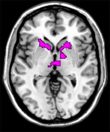 以核磁共振(fMRI)測試腦反應，受到別人稱讚時，腦反應的部分。圖片來源：自然科學研究機構生理學研究所   